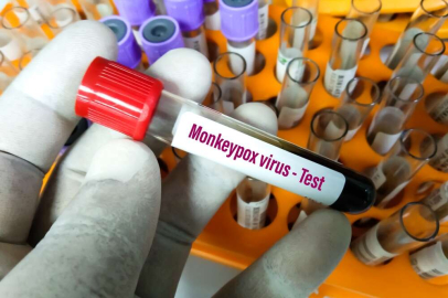 Maymun Çiçeği alarmı