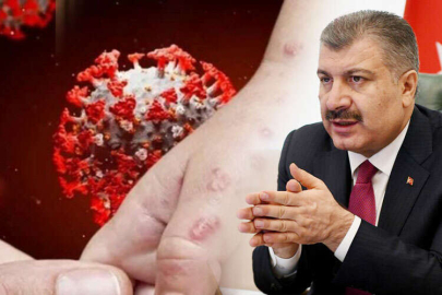 Bakan Koca duyurdu... Türkiye'de 5 maymun çiçeği vakası tespit edildi